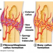 Cissus Quadrangularis – An Effective Bone Healer